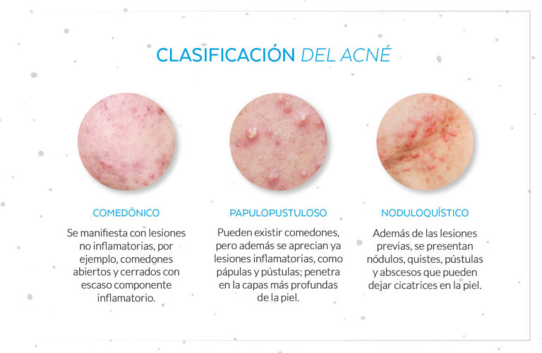 acn-bassa