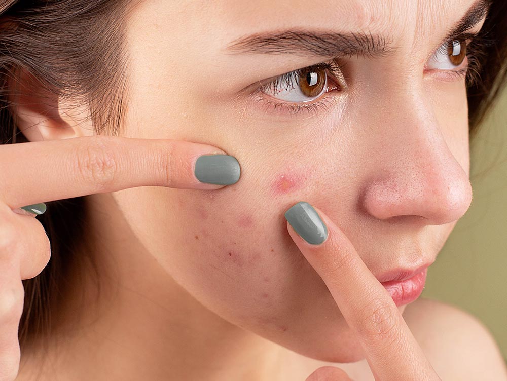tratamiento acné vulgar